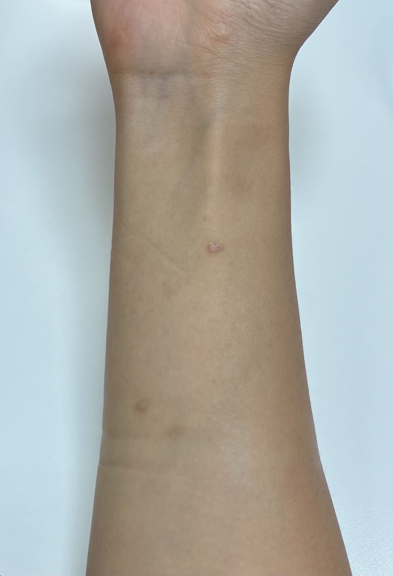 arm with scars lol